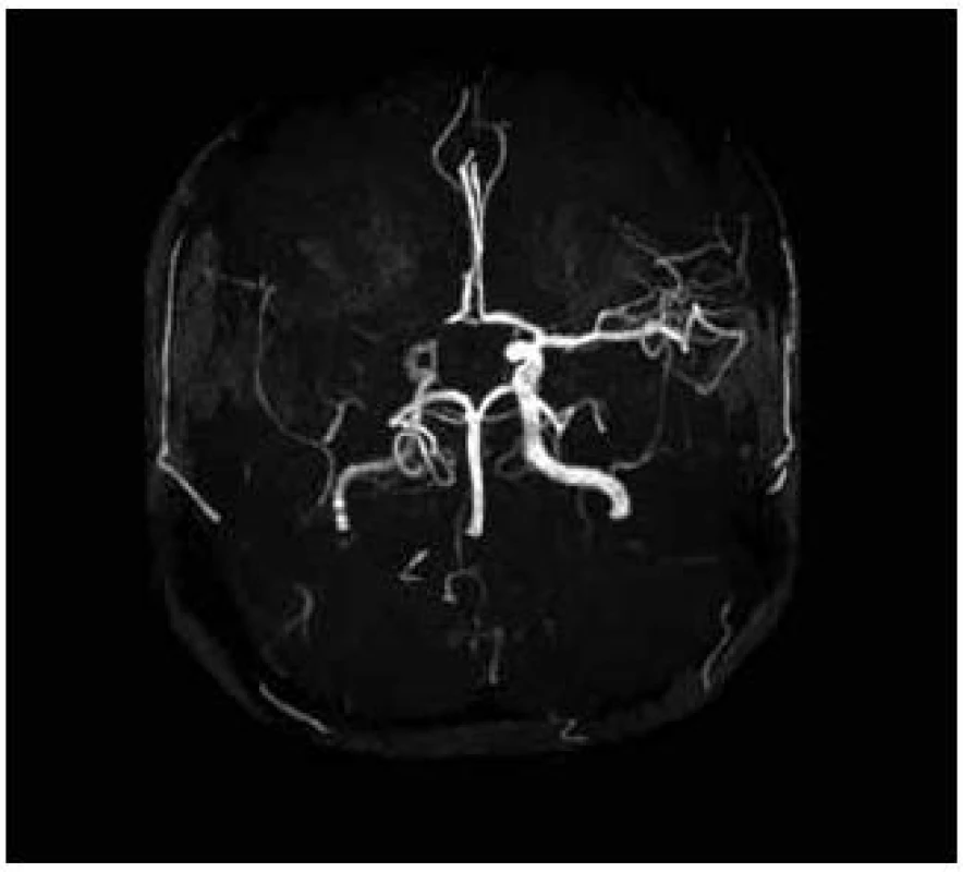 MRA – nativní MR angiografie (Maximal Intensity Projection Rekonstrukce). Patrný je uzávěr ACM a A1 segmentu ACA vpravo.