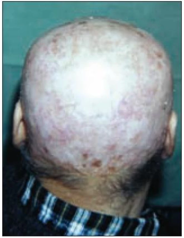 Kůže hlavy pacienta po excizi Ca a po transplantaci kožního laloku.