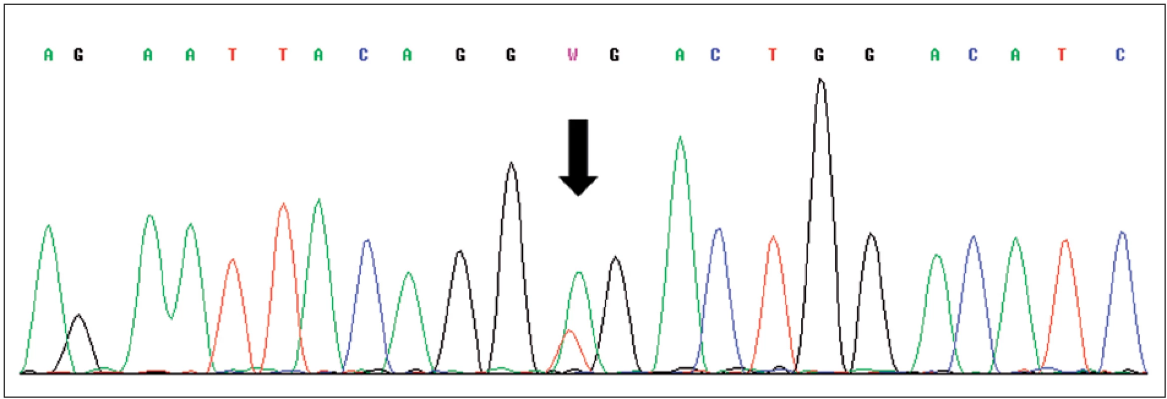 Sekvence části genu VHL, šipka označuje mutaci c.529A&gt;T (p.R177X) v exonu 3
Fig. 3. Sequence of exon 3 of VHL gene with mutation c.529A&gt;T (p.R177X) indicated by arrow