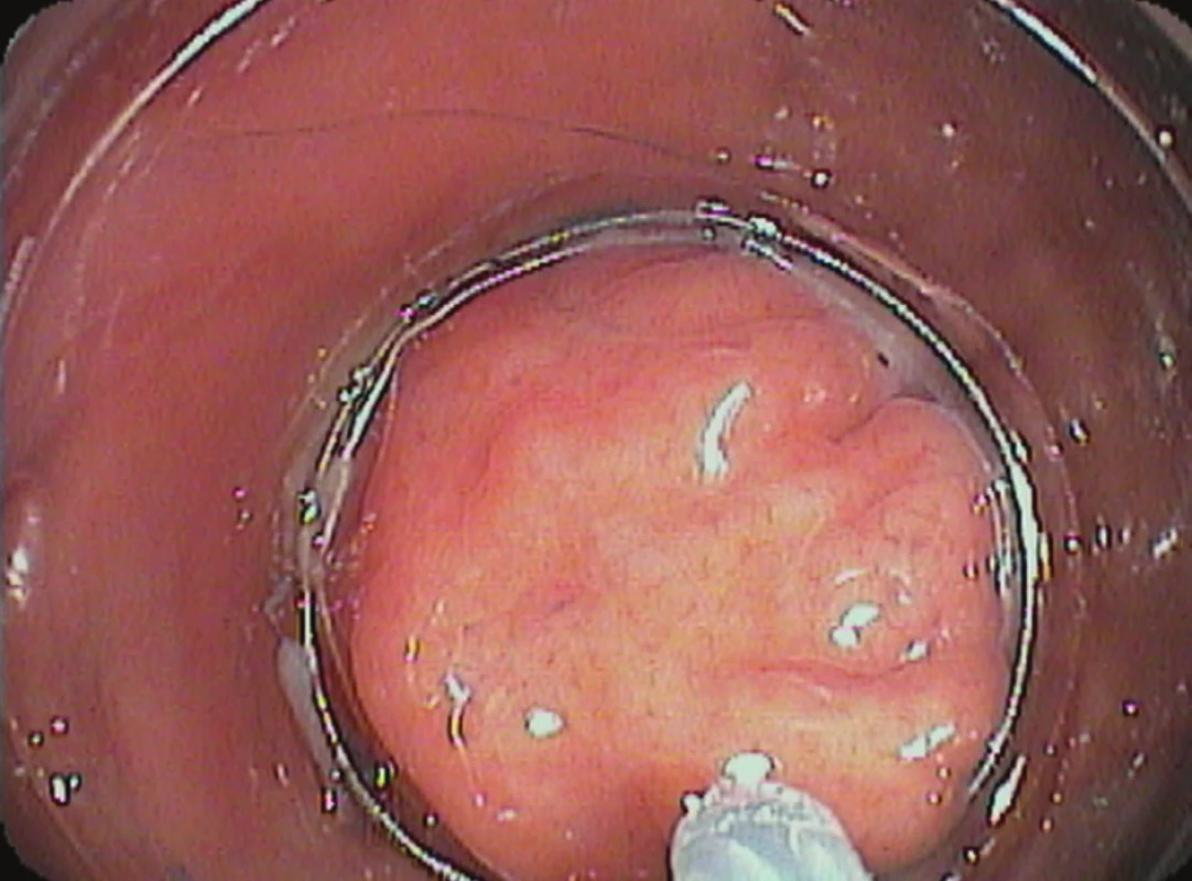 Endoskopická slizniční resekce „suck and cut“: průhledný nástavec s mukozektomickou kličkou v zorném poli