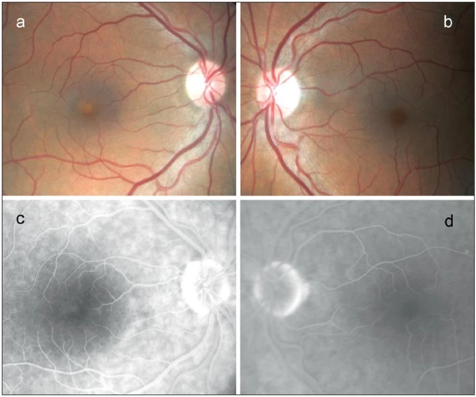 Nález na očním pozadí u 64 letého probanda s Bestovou chorobou potvrzenou molekulárně genetickým vyšetřením. Barevná fotografie sítnice v oblasti makuly pravého oka s prominujícím, subretinálně uloženým, ostře ohraničeným žlutavým ložiskem, okolo jemné přesuny pigmentu a), fotografie sítnice v oblasti makuly levého oka s normálním nálezem b), 9. minuta fluorescenční angiografie pravého oka s velmi mírnou ložiskovou hyperfluorescencí v centru makuly c), 10. minuta fluorescenční angiografie levého oka s normálním nálezem d).