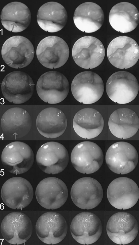 Typy velofaryngeálních uzávěrů – nasoendoskopický obraz (první snímek – maximálního otevření, poslední – maximální uzavření, šipky ukazují pohyb podílejících se struktur).