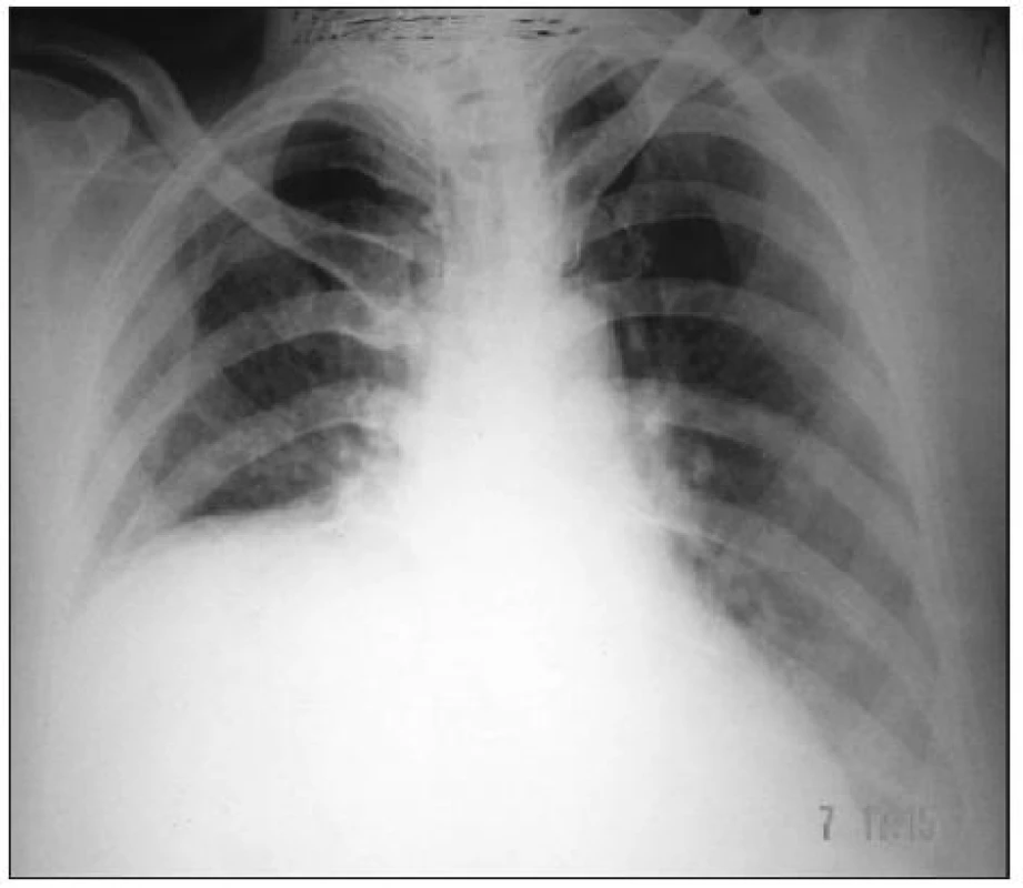 RTG snímek hrudníku s hemidiaphragmatickou parézou vpravo (Kansal, 2009).
