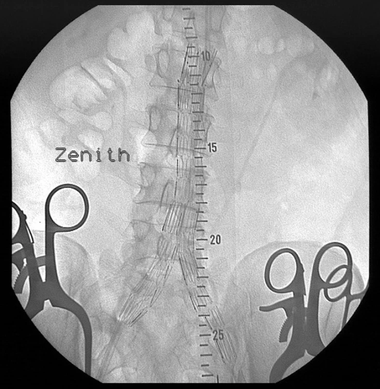 Digitální subtrakční angiografie dolních končetin s viditelným aneuryzmatem podkolenní tepny vlevo.
Pic. 2. Digital subtraction angiography of lower extremities with visible left popliteal artery aneurysm.