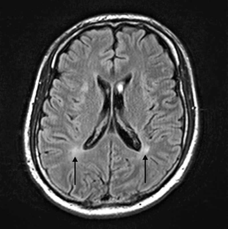 MR mozku, šipkami jsou označené v centrální bílé hmotě při postranních komorách neostře ohraničená ložiska zvýšené intenzity signálu.