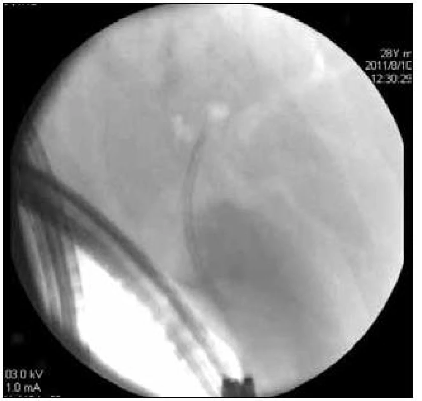 ERC u pacienta z obr. 6, kdy stenóza HJA byla úspěšně překlenuta endoskopicky zavedeným plastovým 7Fr biliárním stentem.