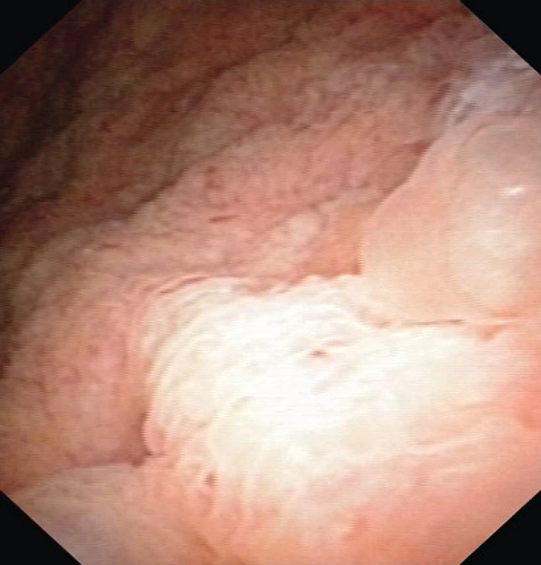 Cystoskopie před operací
Fig. 1. Cystoscopy prior TUR
