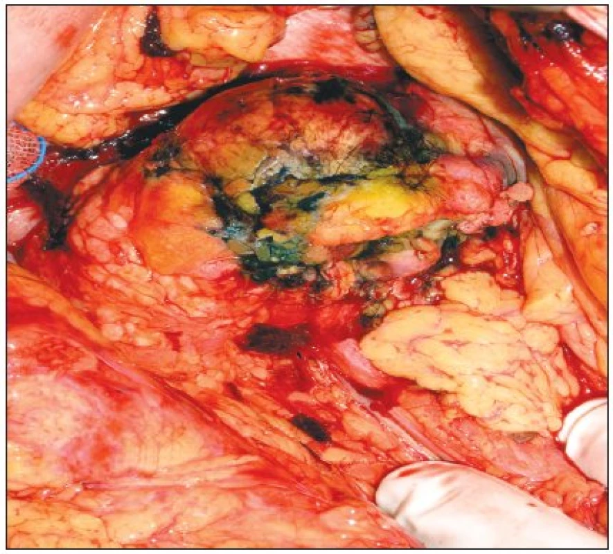 Stejný tumor po provedení RFA
Fig. 2. The same tumor following the RFA procedure