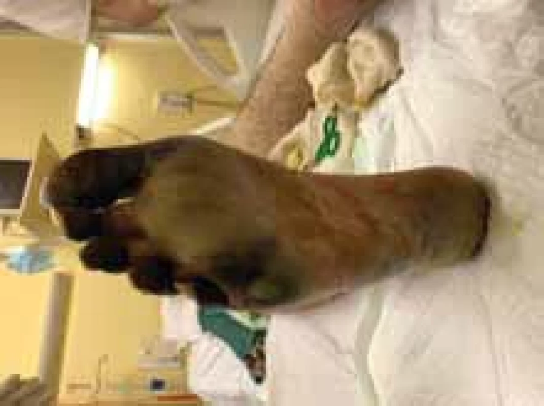 Appearance of right foot with necrosis of toes and metatarsals (plantar view).