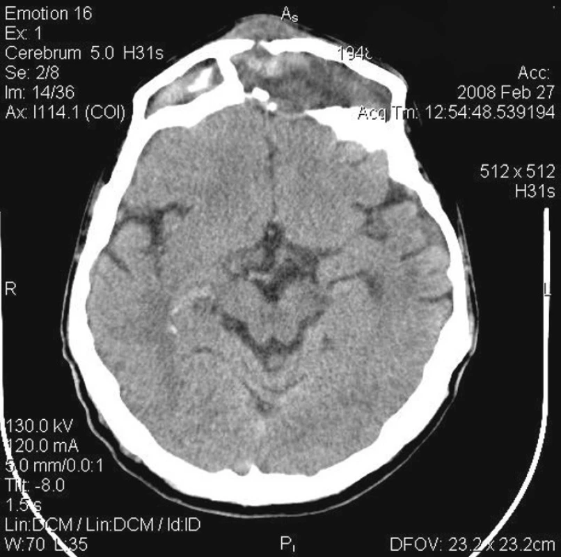 CT vyšetření v axiální projekci zobrazuje expanzivně se chovající masu nádorového procesu vycházejícího z čelní dutiny s destrukcí přední a zadní stěny sinu.