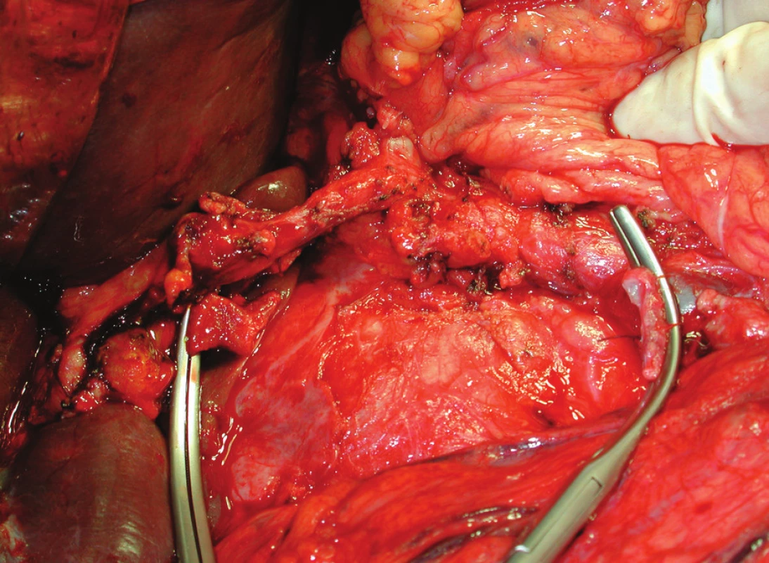 Pankreatoduodenektomie s resekcí porty, stav po odstranění preparátu