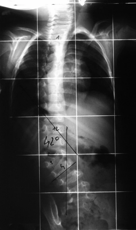 Předoperační zadopřední rtg snímek vrozené skoliózy s poruchou formace třetího bederního obratle.
Fig. 1. Preoperative anterior-posterior X-ray, long spine format of congenital scoliosis with apparent hemivertebra in the area 3rd lumbar vertebra.