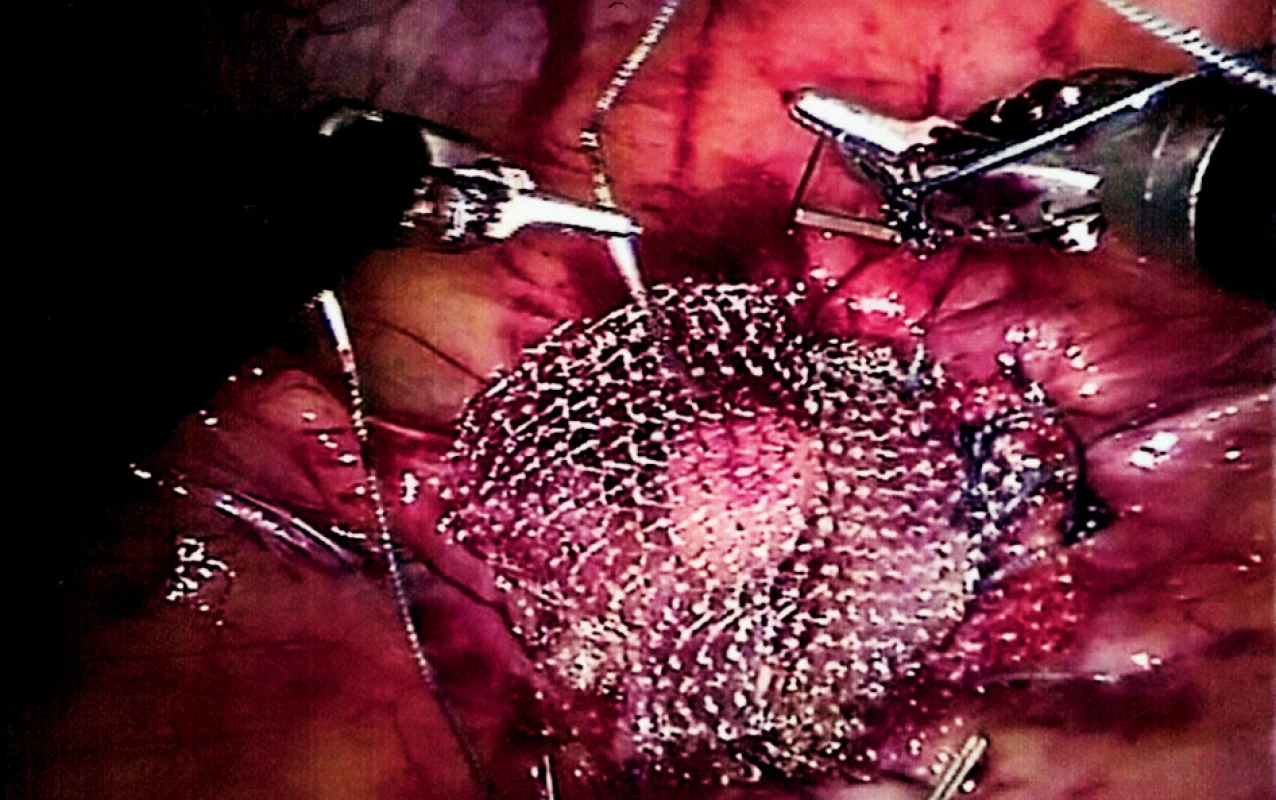 Robotický uzávěr kýlní branky prolenovou síťkou
Fig. 5. Robotic hernioplasty using a prolene mash