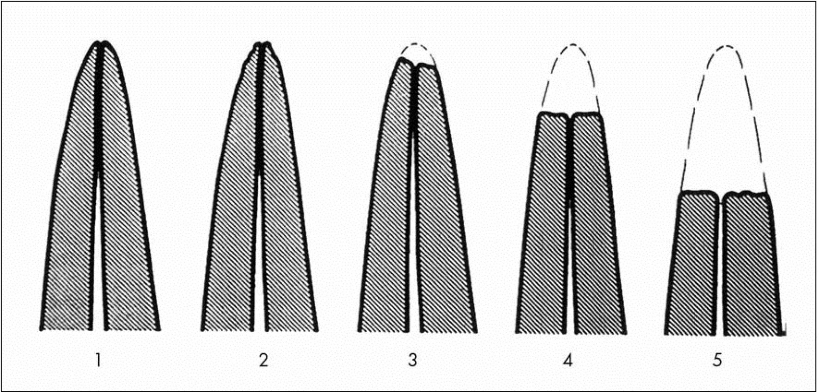 Schematický nákres hodnocení rozsahu apikálních kořenových resorpcí [20]
