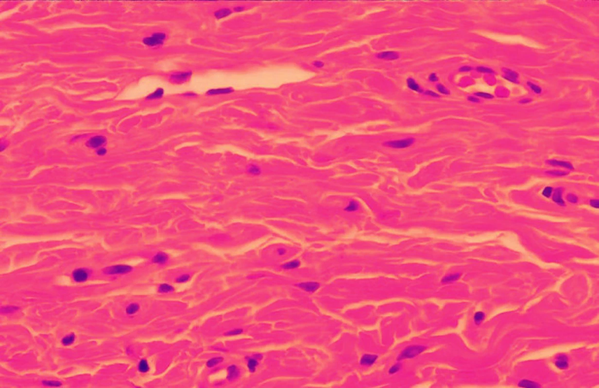 Papillae coronae glandis, histologcký nález – zhrubûní kolagenních snopců se zmnožením fibroblastů veřetenitého, oválného, či cípatého (hvězdicovitého) vzhledu (HE-60x).