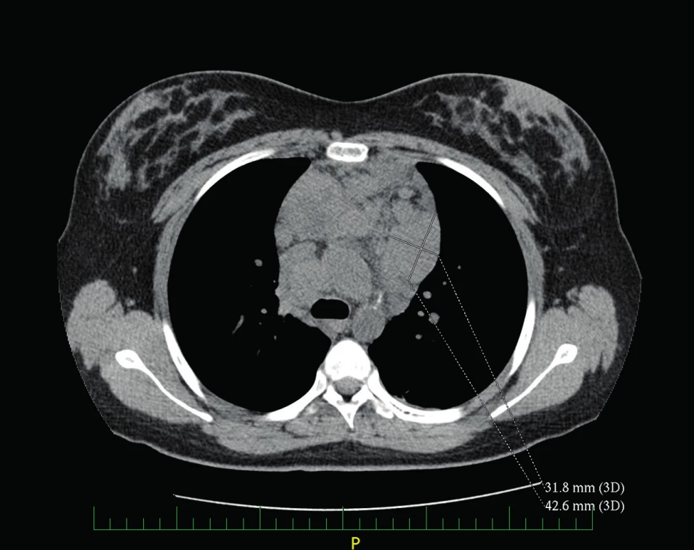 CT hrudníku – lymfadenopatie horního mediastina.
Fig. 2. Chest CT – superior mediastinum adenopathy.
