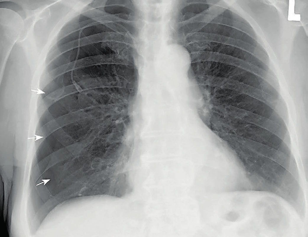 Skiagram hrudníku prokazuje parciální pneumothorax vpravo s jasně viditelnou linií viscerální pleury částečně kolabované pravé plíce (šipky)