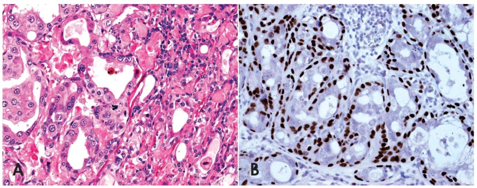 Neinvazivní (in-situ) karcinom ex pleomorfní adenom (PA) neprorůstá přes okraje „ mateřského“ PA, obsahuje atypie, mitózy a vysokou proliferační aktivitu výhradně v luminální duktální vrstvě původního PA se zachovanou intaktní myoepiteliální vrstvou (A), HE, 400x. Imunohistochemická reakce s p63 je pozitivní v abluminální vrstvě původních nenádorových myoepitelií (B), 400x.