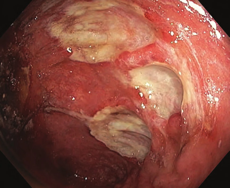 Ulcerace v orální polovině pahýlu rekta.
Fig. 3. Ulcers in the oral part of the rectal stump.