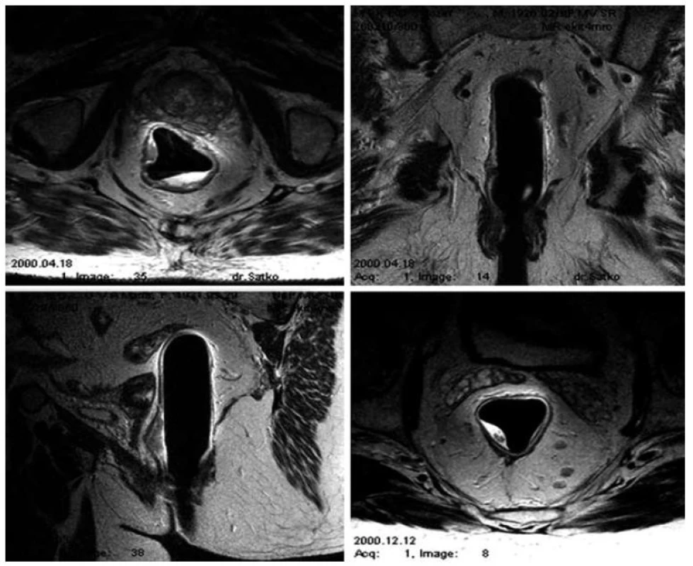 MRI – Endorektálny predterapeutický staging.
Fig. 1. MRI – endorectal pretherapeutic staging.
