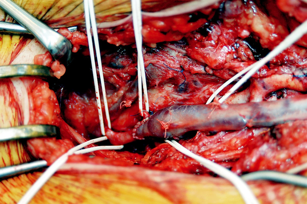 Detail distální anastomózy (end to side) žilního štěpu ke kmeni arteria profunda femoris asi 8 cm pod jejím odstupem ze společné stehenní tepny, která je po explantaci infikované cévní protézy ztrombozovaná. Arteria femoralis superficialis je chronicky uzavřena
Fig. 4. Detail of distal anastomosis (end-to-side) of the venous graft to the deep femoral artery trunk at about 8 cm below its division from the common femoral artery which was thrombolized after infected prosthesis explantation. The superficial femoral artery was chronically occluded
