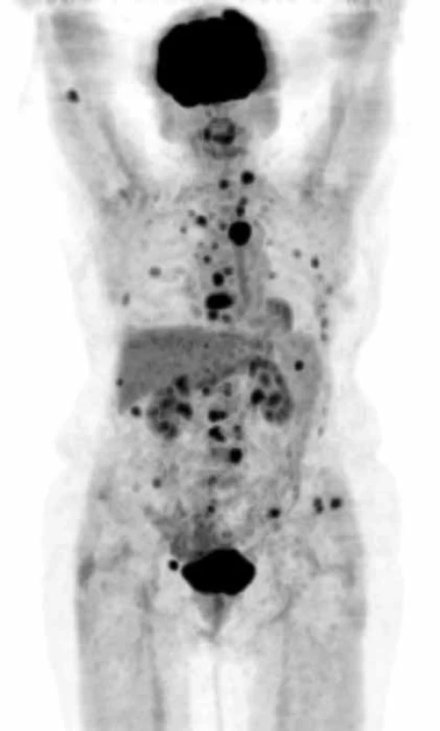 PET CT zobrazí postižení skeletu
MIP obraz (maximum intensity projections) biodistribuce FDG ve snímané oblasti, mimo fyziologickou aktivitu (v mozkové kůře, patrových tonzilách, ledvinách a močovém měchýři) se zobrazují četná hypermetabolická ložiska ve skeletu od kalvy až po pánevní kosti.
