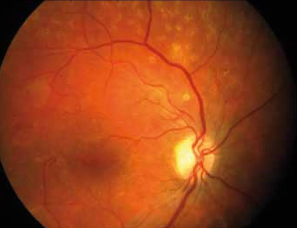 Stabilizace nálezu na sítnici pravého oka po opakovaném laserovém ošetření.