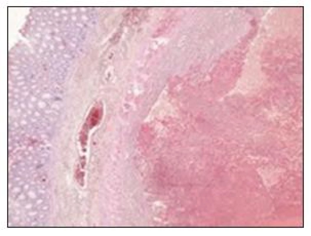 Rozsiahle krvácanie v subseróznom tukovom tkanive mezenteria
Fig. 9. Massive bleeding in the mesenteric subserous adipose tissue