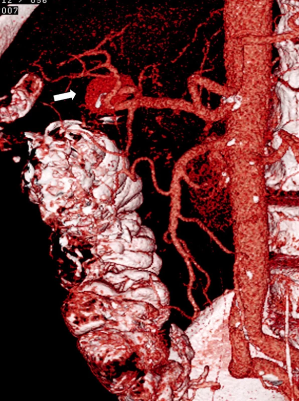CT angiografie, 1. rekonstrukce – v horní části je patrná pseudovýduť arteria hepatica dextra (označeno šipkou)
Fig. 1. CT angiography, 1st reconstruction – proximally, a pseudoaneurysm of the right hepatic artery is detectable (marked with arrow)