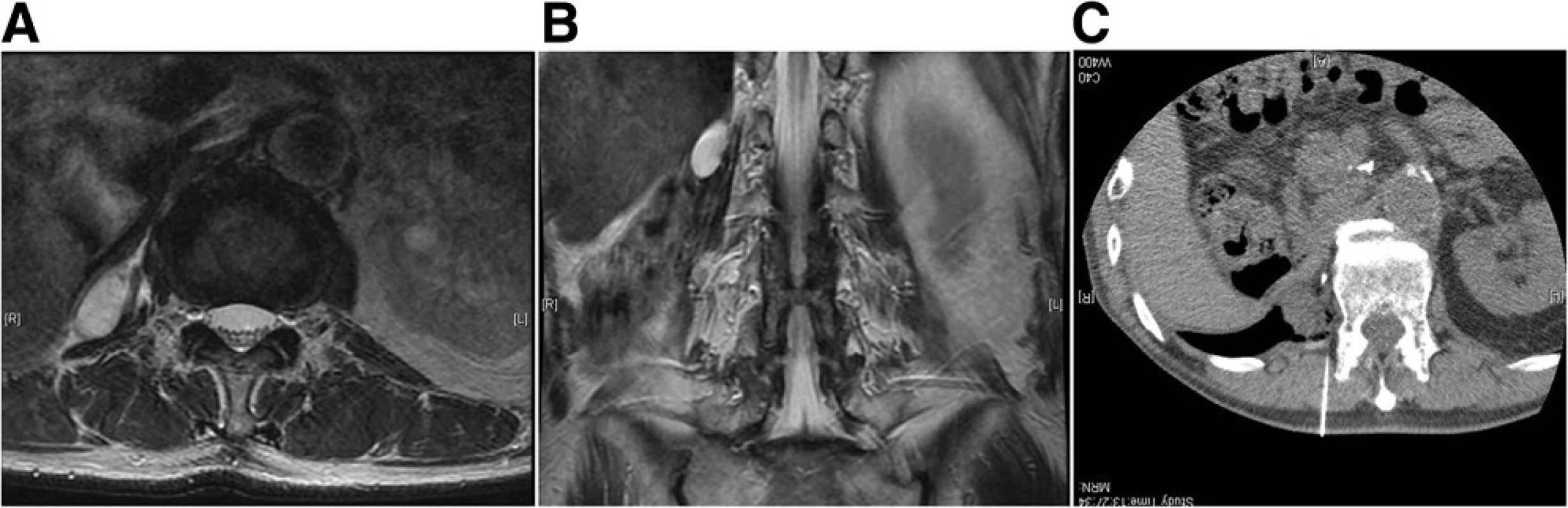Locally recurrent, 3 cm, dedifferentiated liposarcoma in the retroperitoneal paravertebral region 1 year after initial surgery (a, b). c Under CT guidance, air was transperitoneally infused to displace the bowel just adjacent to the recurrent tumor