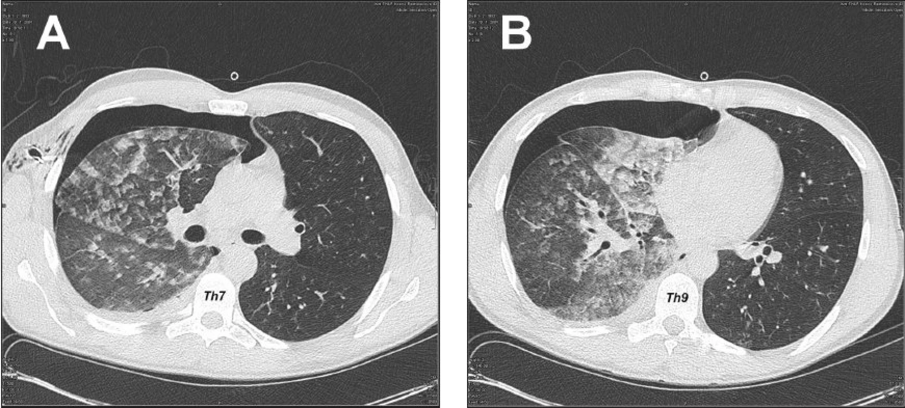 CT hrudníka 5 hod po drenáži hrudníkovej dutiny, svedčiace najskôr pre prítomnosť alveolárneho edému vpravo, s incipientnými známkami edematóznych zmien aj v ľavých pľúcach, fluidotorax vpravo a PNO vpravo (A – transverzálny rez v úrovni 7. hrudného stavca, B – transverzálny rez v úrovni 9. hrudného stavca)
Fig. 3. Thoracic CT 5 hours following drainage of the thoracic cavity, suggesting presence of alveolar edema on the right, with incipient signs of edematous changes in the left lung, fluidothorax on the right and pneumothorax on the right (A – transverse section at the T-7level , B – transverse section at the T-9 level )