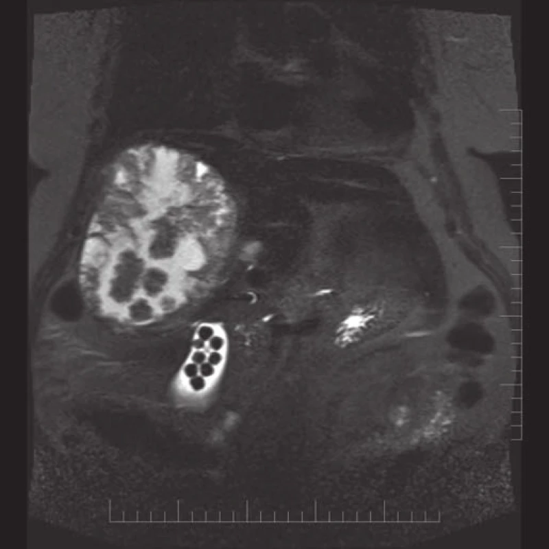 MRI snímky doplněné v MOÚ na přání infekcionisty, na snímcích jsou patrné echinokokové cysty a kameny ve žlučníku.