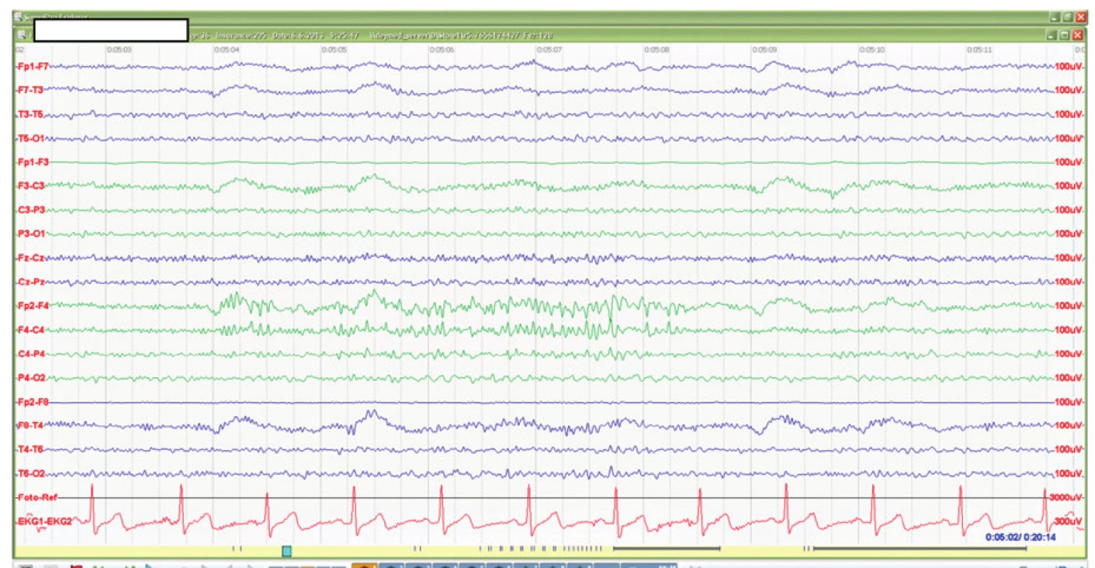 EEG u posttraumatické epilepsie po kontuzi mozku