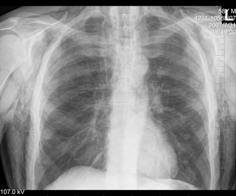 Rentgenový snímek plic
Fig. 3. Chest X-ray