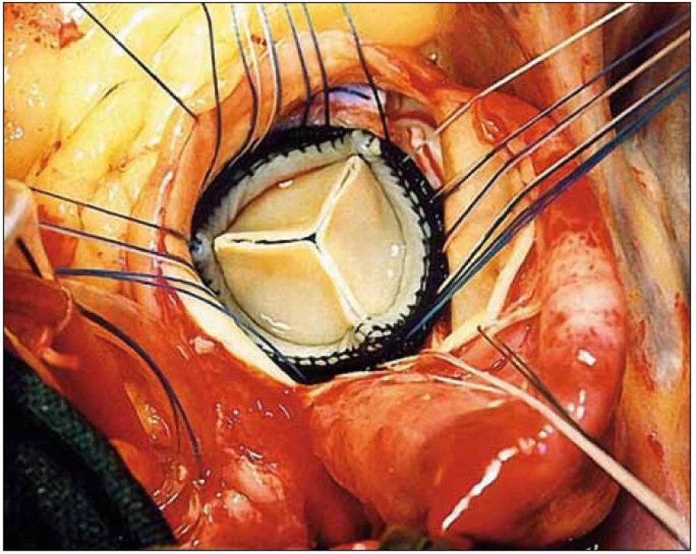 Náhrada stenotické aortální chlopně bioprotézou klasickou operací.