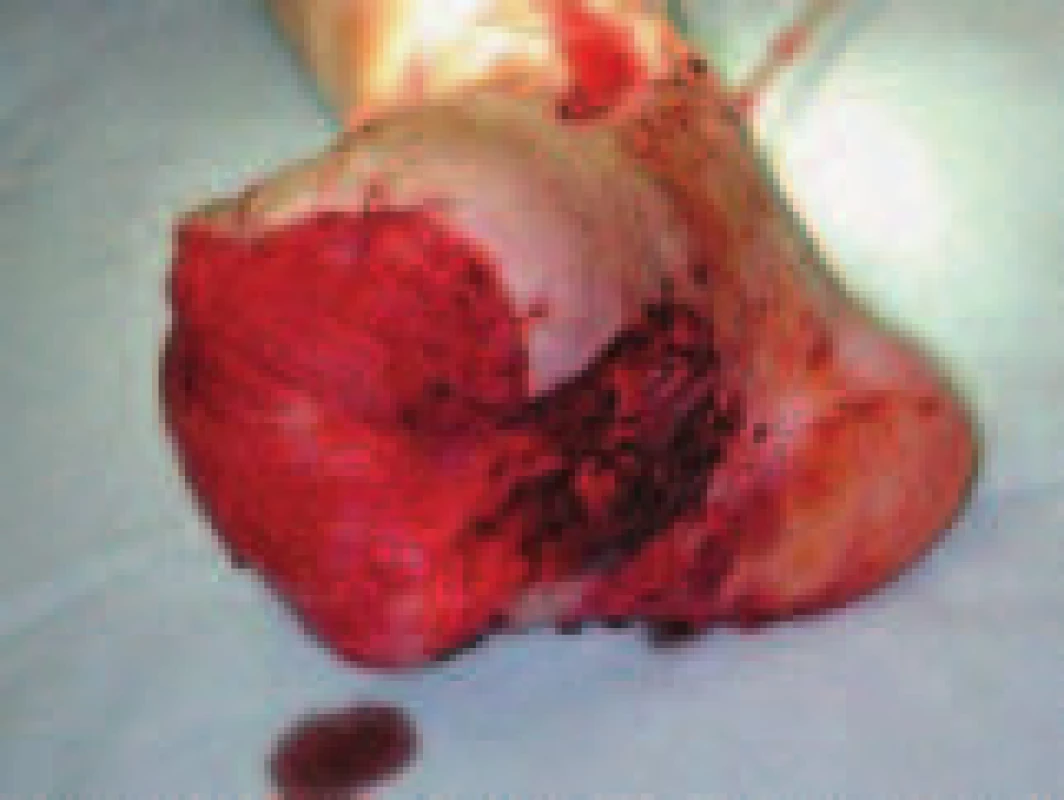 Peroperační snímek zachycující nohu s volným svalovým lalokem v defektu po amputaci všech prstů a  rozsáhlé nekrektomii planty.