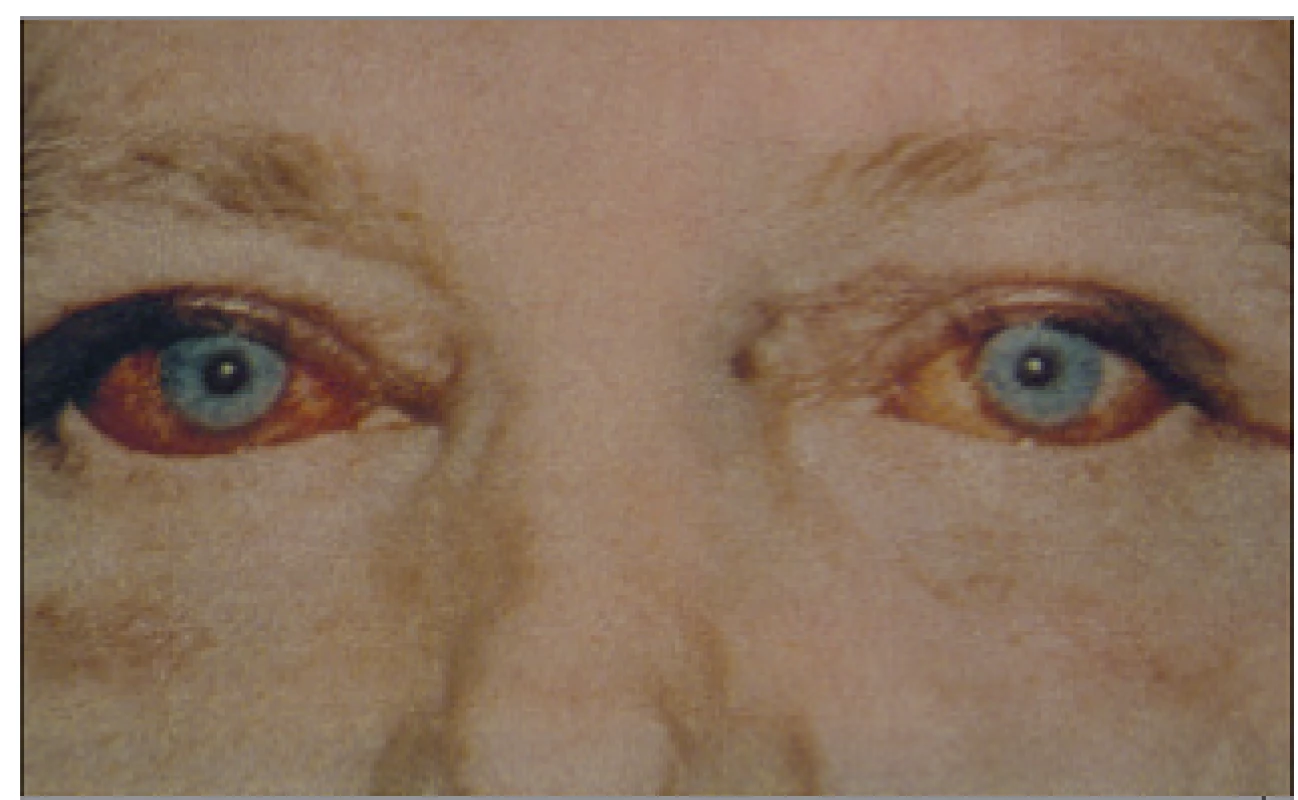 Mimokostní kalcifikace ve spojivkách, tzv. syndrom červených očí.