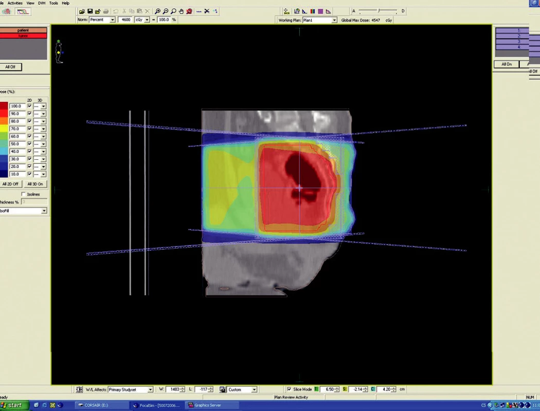 Plánovací CT vyšetření – předoperační ozáření karcinomu rekta cT3 NO MO – sagitální rovina