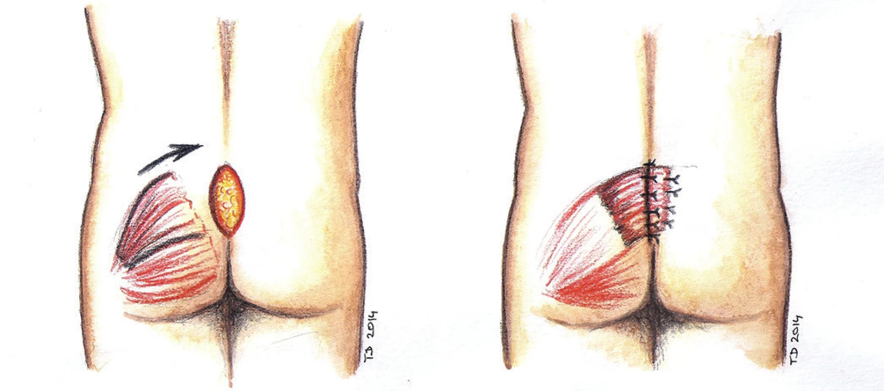 Lalokový posun za použití svalu - schéma
Fig. 7: Muscle flap reconstruction - scheme