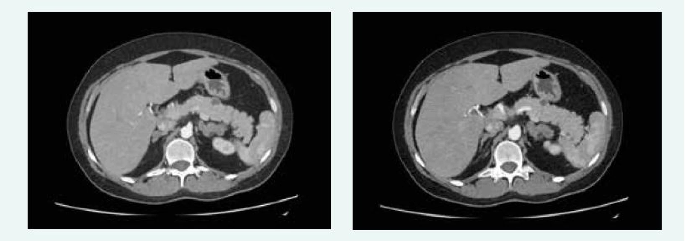 Kazuistika 5 – afunkční neuroendokrinní tumory slinivky (CT) (snímky v plném rozlišení naleznete v on-line verzi článku)