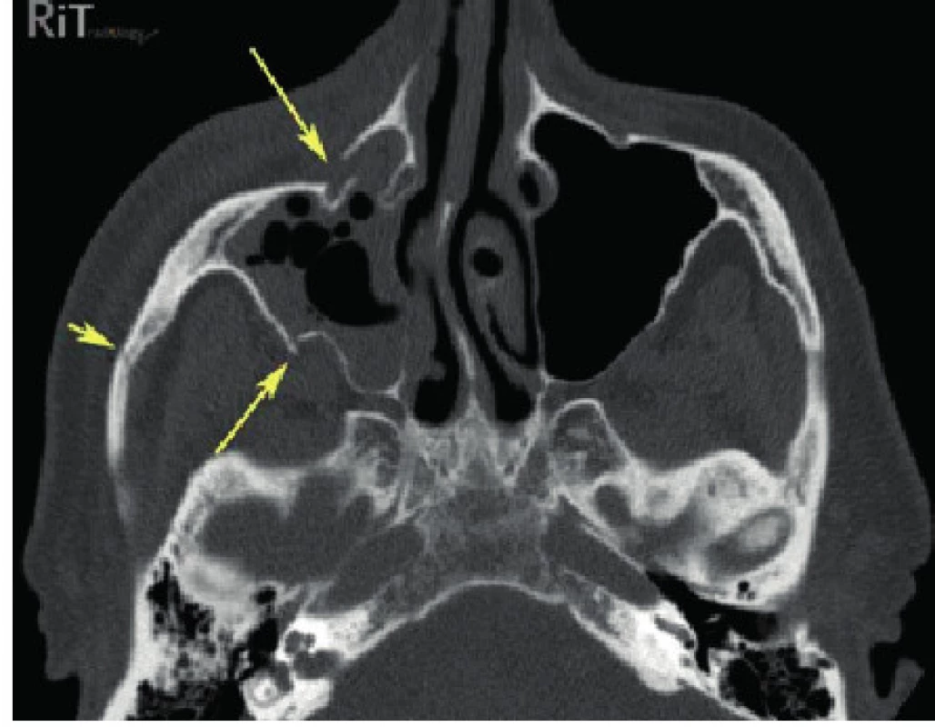 CT scan zlomeniny lícně-čelistního komplexu