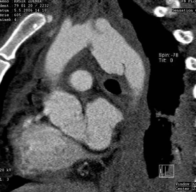 Poranění hrudní aorty v isthmické části
Fig. 1: Thoracic aortic injury in the isthmic area