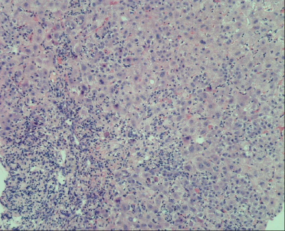 Fokální nekróza hepatocytů v centrálnější části lobulu s kulatobuněčnou reakcí včetně plazmocytů a s makrofágy 
Apoptotické jaterní buňky (barvení HE).