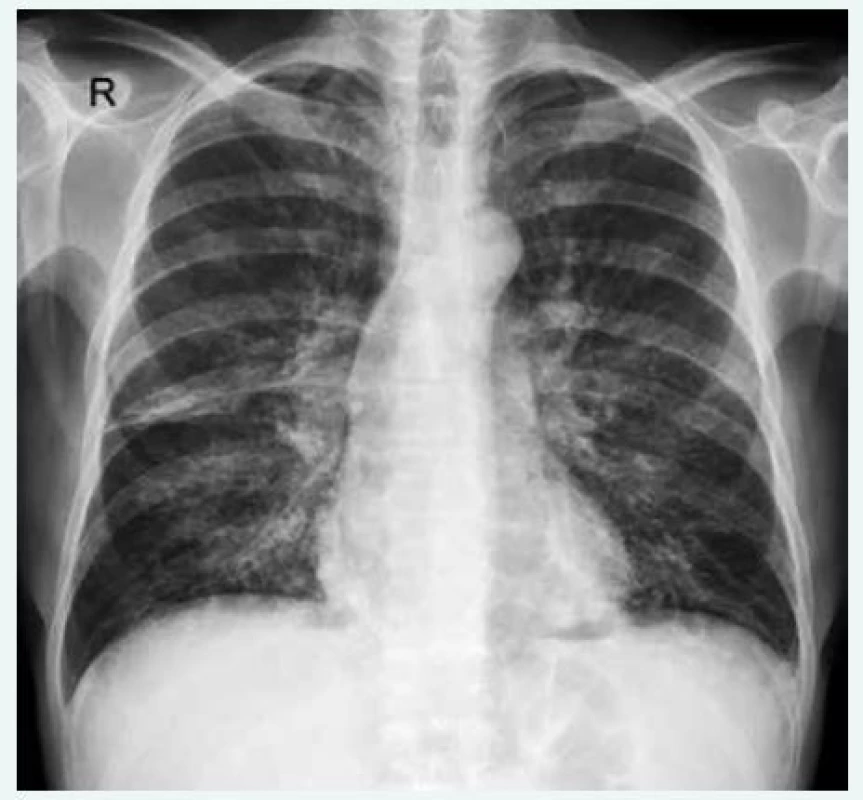 Zadopřední snímek hrudníku u pacienta s běžným variabilním imunodeficitem (CVID) a intersticiálním plicním postižením s bronchiektáziemi. Nehomogenní retikulární zastínění je přítomno oboustranně difuzně. RTG-snímky poskytla MUDr. Martina Doubková