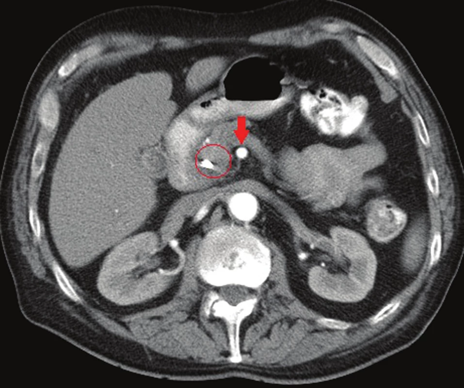 CT břicha, arteriální fáze, šipka označuje volný kmen AMS, v kruhu tumor hlavy pankreatu s biliárním stentem