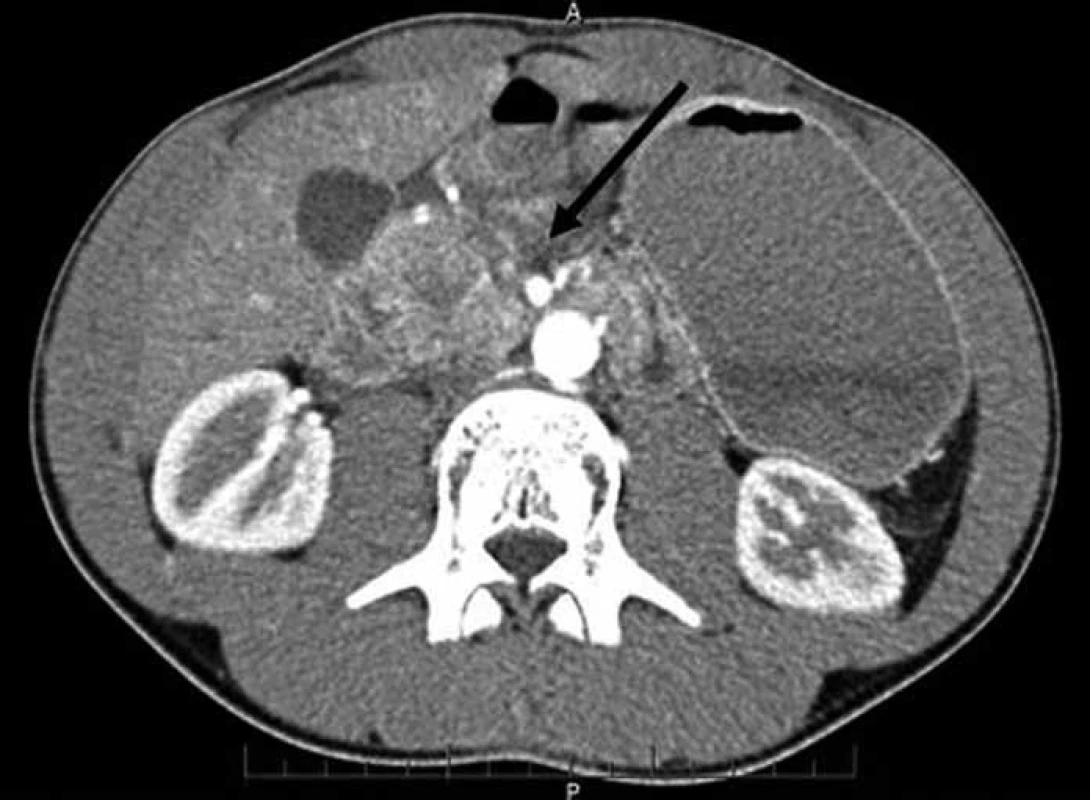 CT břicha – lacerace v oblasti hlavy pankreatu (šipka).
Fig. 1. Abdominal CT scan – laceration of the pancreatic head (arrow).