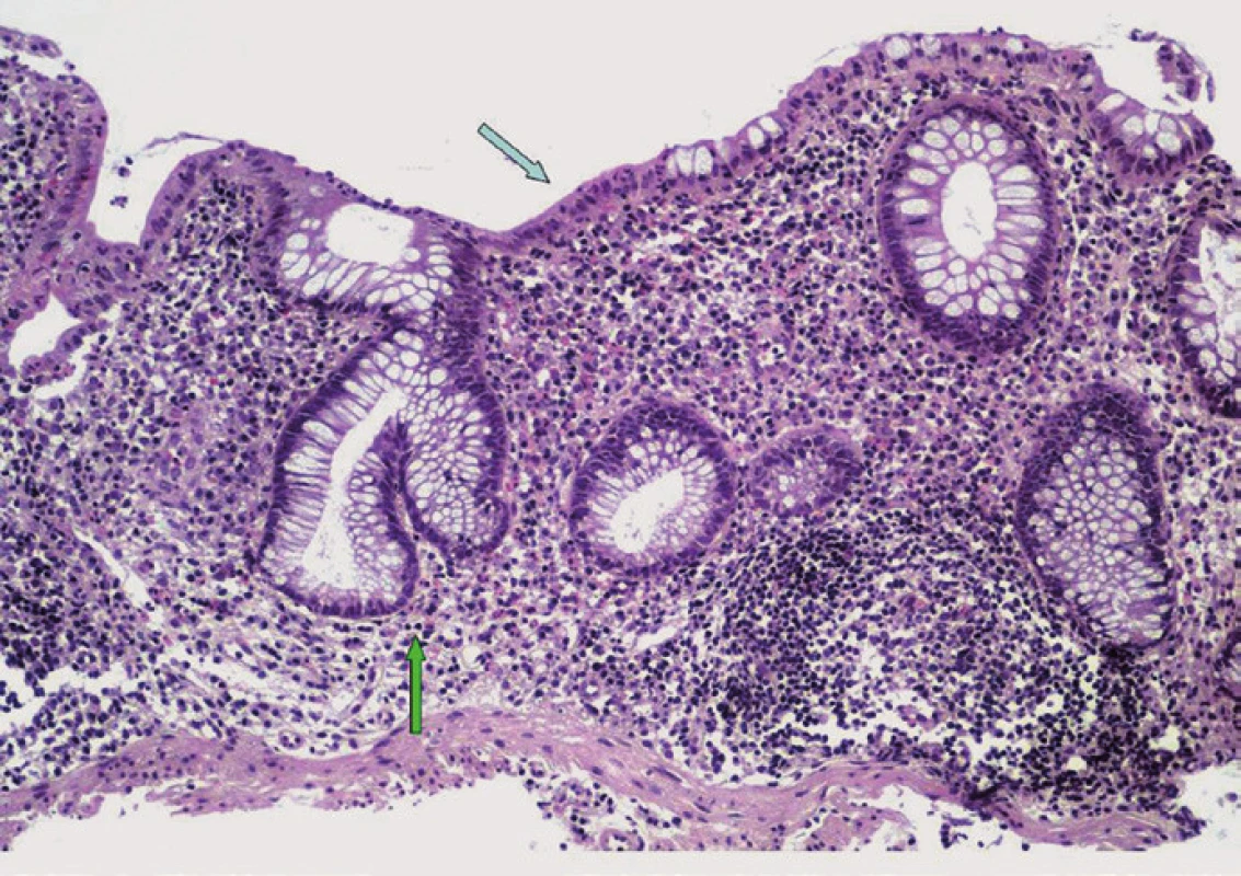 Histologický obraz PSC-IBD. Narušená slizniční architektonika s větvením a zkrácením Lieberkühnových krypt (bílá šipka), s nečetnými neutrofilními leukocyty mezi epiteliemi povrchové výstelky (černá šipka), chronický zánětlivý infiltrát v lamina propria mucosae (hematoxylin-eozin, původní zvětšení ×100).
Fig. 2. Histopathological features of PSC-IBD. Mild chronic active colitis characterized by architectural distortion of the intestinal mucosa with branched and shortened crypts (white arrow); neutrophils are focally present within the lamina propria and surface epithelium (black arrow); the lamina propria is expanded by chronic inflammatory infiltrate (hematoxylin-eosin, original magnification ×100).