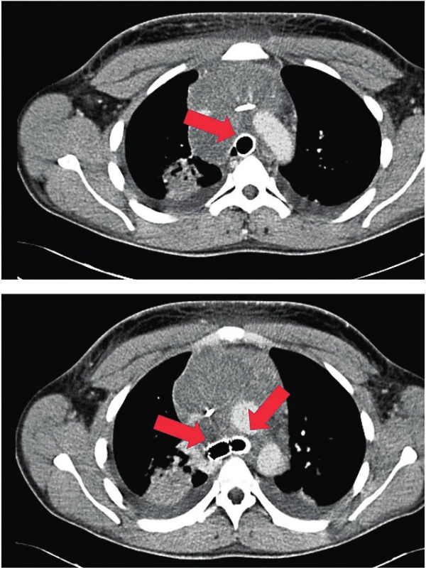 Kontrolní CT snímek se stentem zavedeným do trachey a obou bronchů – šipky
