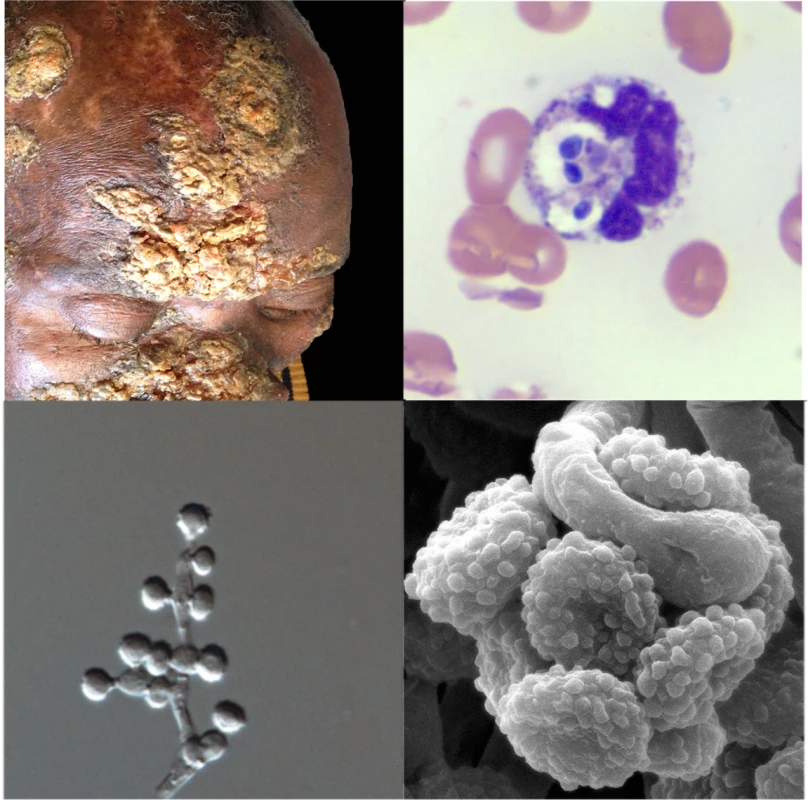 Clinical, pathological, and mycological facets of a novel <i>Emmonsia</i>-like fungus reported from South Africa.