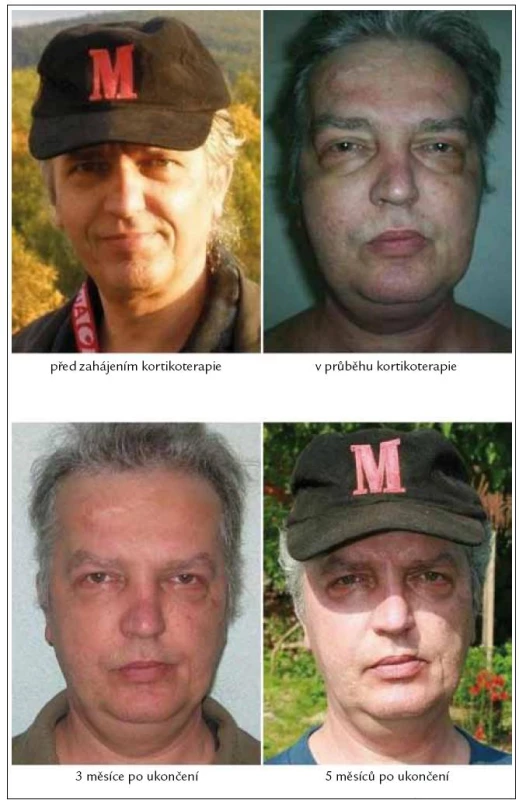 Změny koloritu pacientova obličeje před, v průběhu a po ukončení kortikoidní léčby.
Fotografická dokumentace této kazuistiky je publikována s písemným souhlasem sledovaného pacienta.